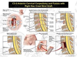 Female C3-5 Anterior Cervical Corpectomy and Fusion with Right Iliac Crest Graft