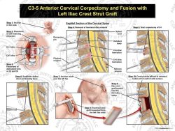 Female C3-5 Anterior Cervical Corpectomy and Fusion with Left Iliac Crest Graft