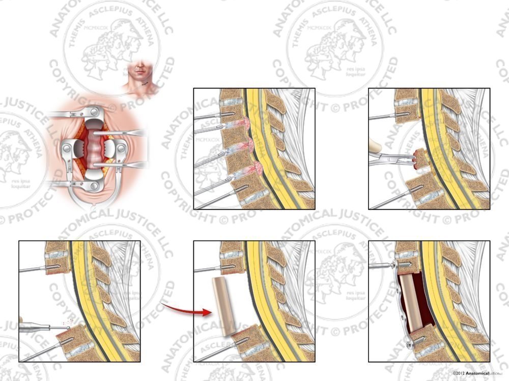C3-6 Anterior Cervical Corpectomy and Fusion with Fibular Strut Graft – No Text