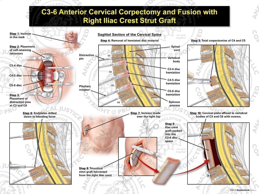 Male C3-6 Anterior Cervical Corpectomy and Fusion with Right Iliac Crest Graft