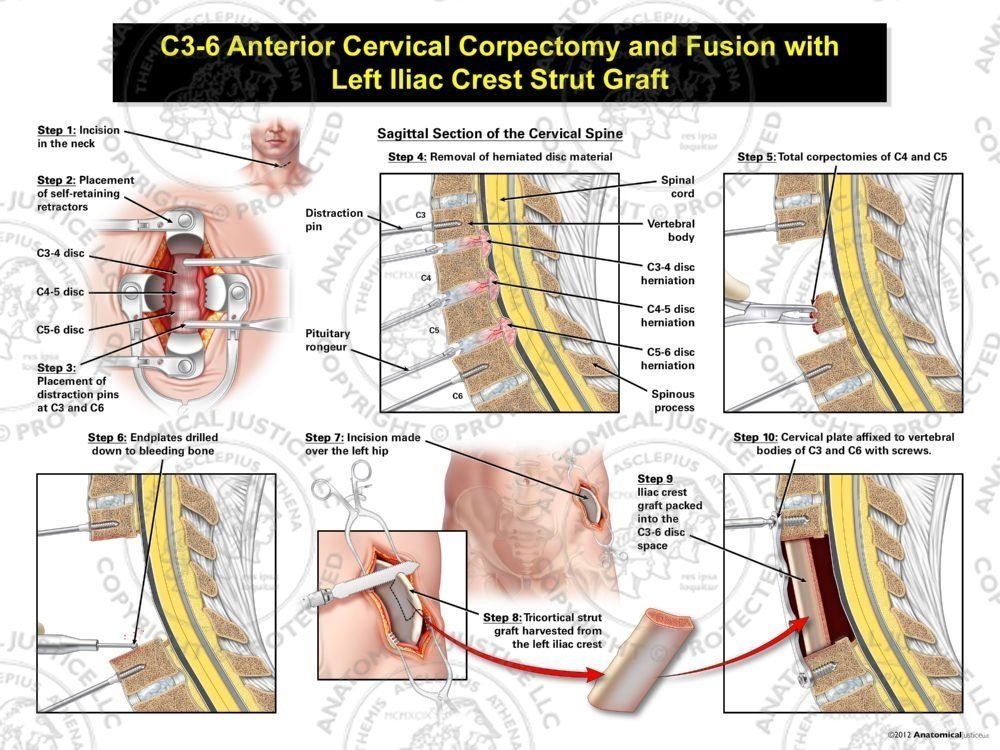Male C3-6 Anterior Cervical Corpectomy and Fusion with Left Iliac Crest Graft