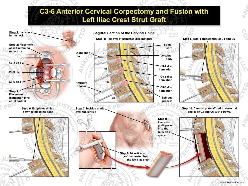 Female C3-6 Anterior Cervical Corpectomy and Fusion with Left Iliac Crest Graft