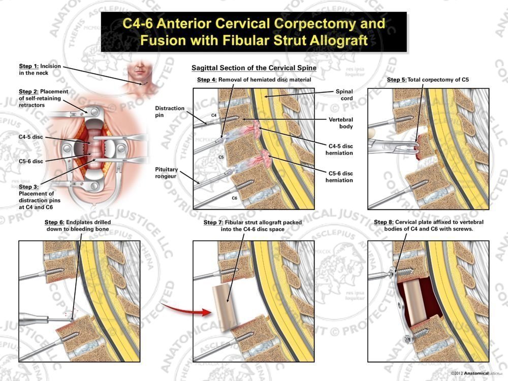 C4-6 Anterior Cervical Corpectomy and Fusion with Fibular Strut Graft