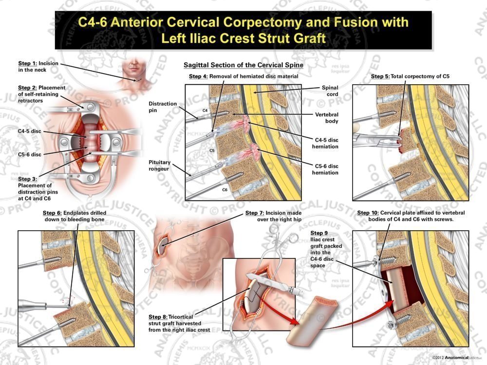 Male C4-6 Anterior Cervical Corpectomy and Fusion with Right Iliac Crest Graft