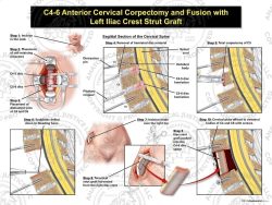 Female C4-6 Anterior Cervical Corpectomy and Fusion with Right Iliac Crest Graft
