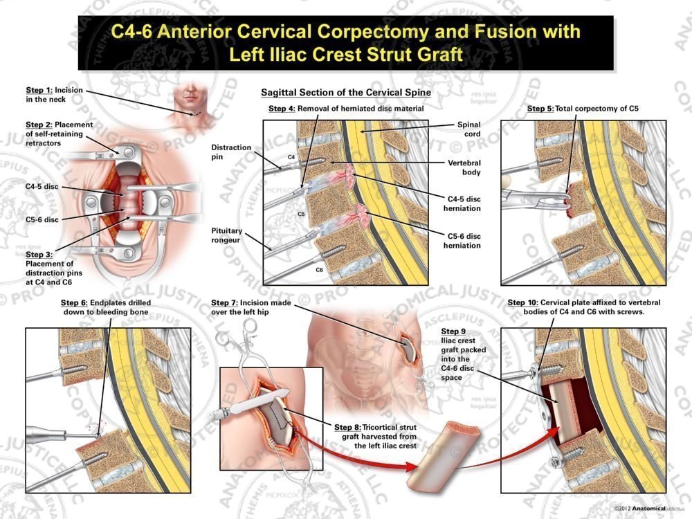 Male C4-6 Anterior Cervical Corpectomy and Fusion with Left Iliac Crest Graft