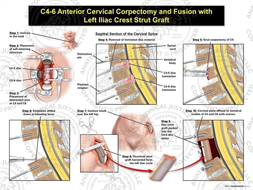 Female C4-6 Anterior Cervical Corpectomy and Fusion with Left Iliac Crest Graft