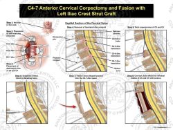 C4-7 Anterior Cervical Corpectomy and Fusion with Fibular Strut Graft