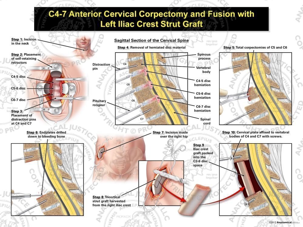 Male C4-7 Anterior Cervical Corpectomy and Fusion with Right Iliac Crest Graft