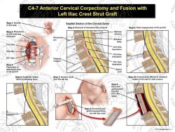 Female C4-7 Anterior Cervical Corpectomy and Fusion with Left Iliac Crest Graft