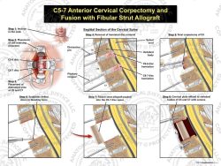 C5-7 Anterior Cervical Corpectomy and Fusion with Fibular Strut Graft