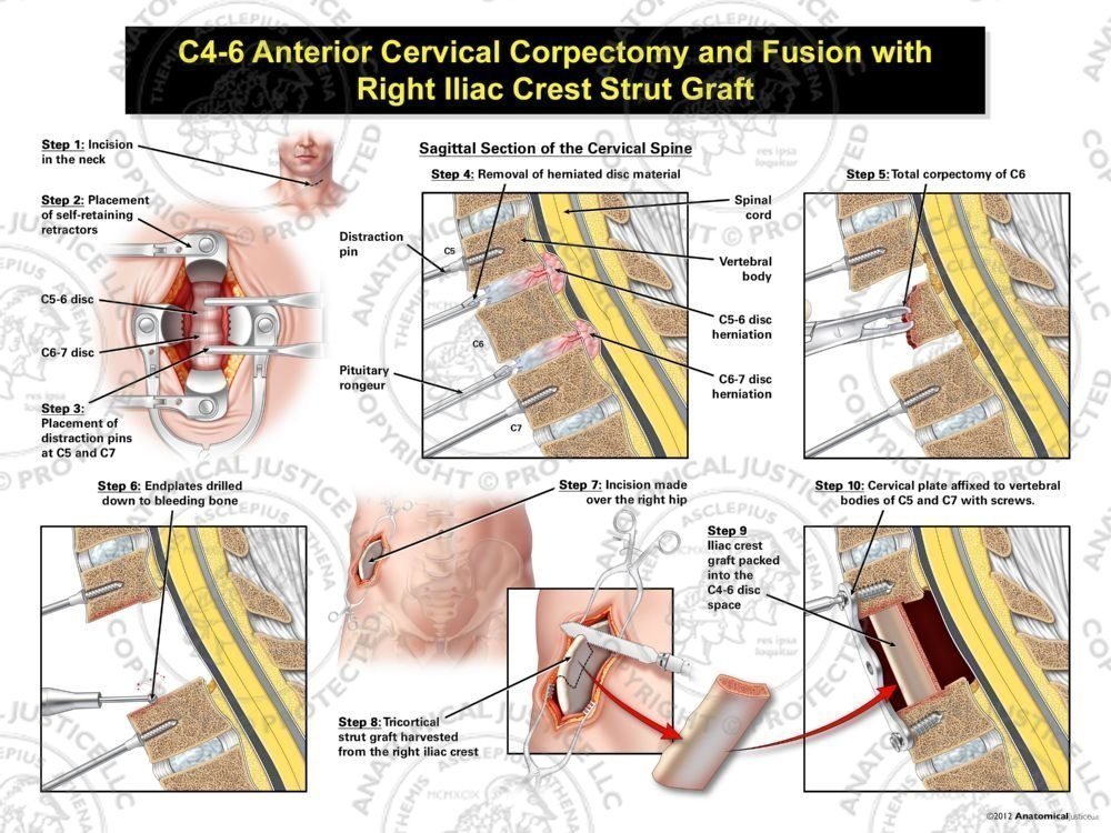 Male C5-7 Anterior Cervical Corpectomy and Fusion with Right Iliac Crest Graft