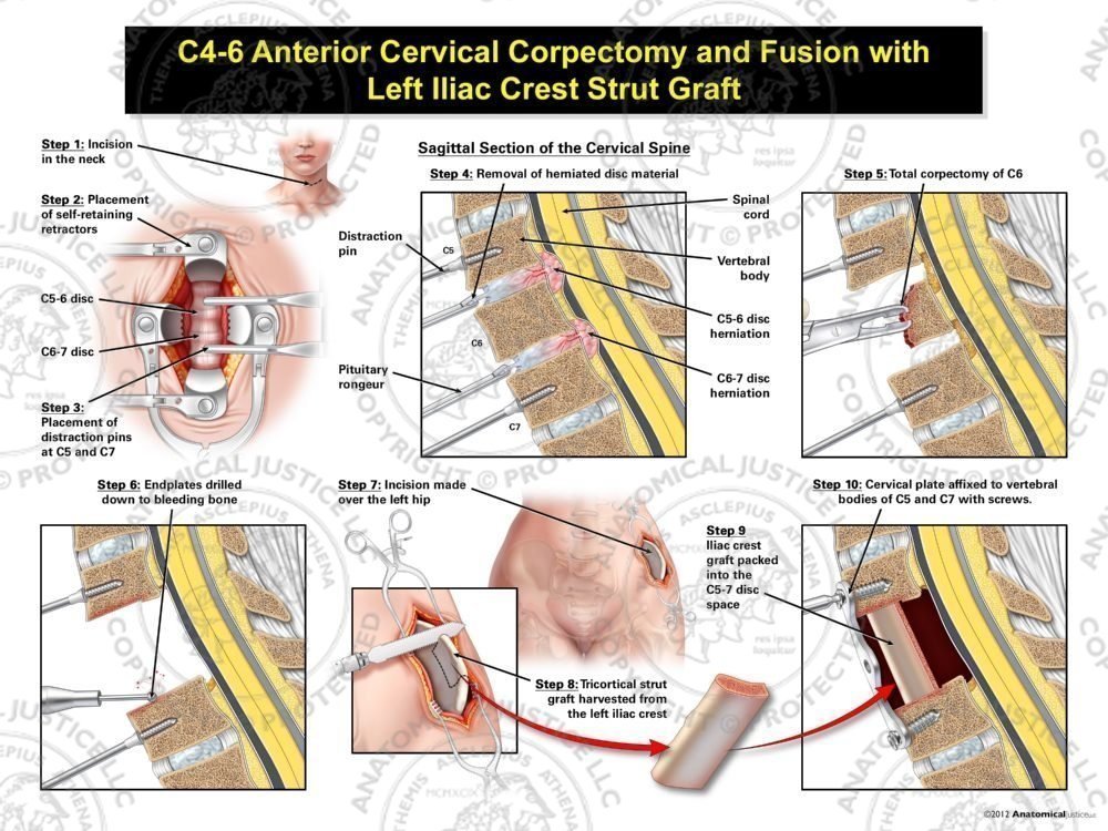 Female C5-7 Anterior Cervical Corpectomy and Fusion with Left Iliac Crest Graft