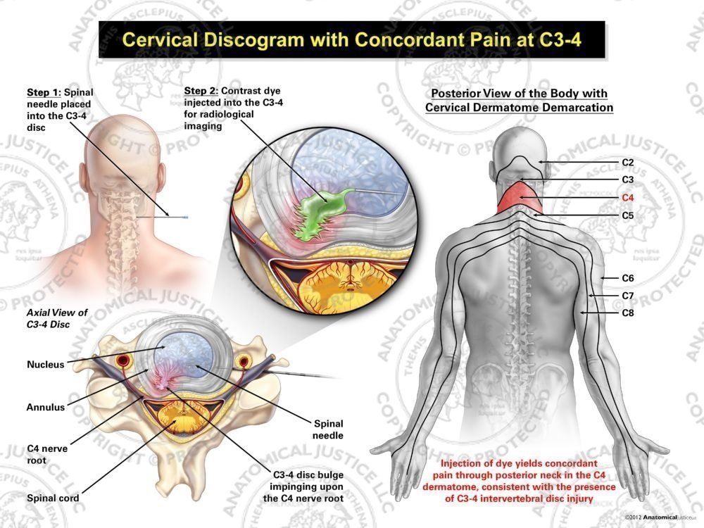 Male Right Cervical Discogram with Concordant Pain at C3-4