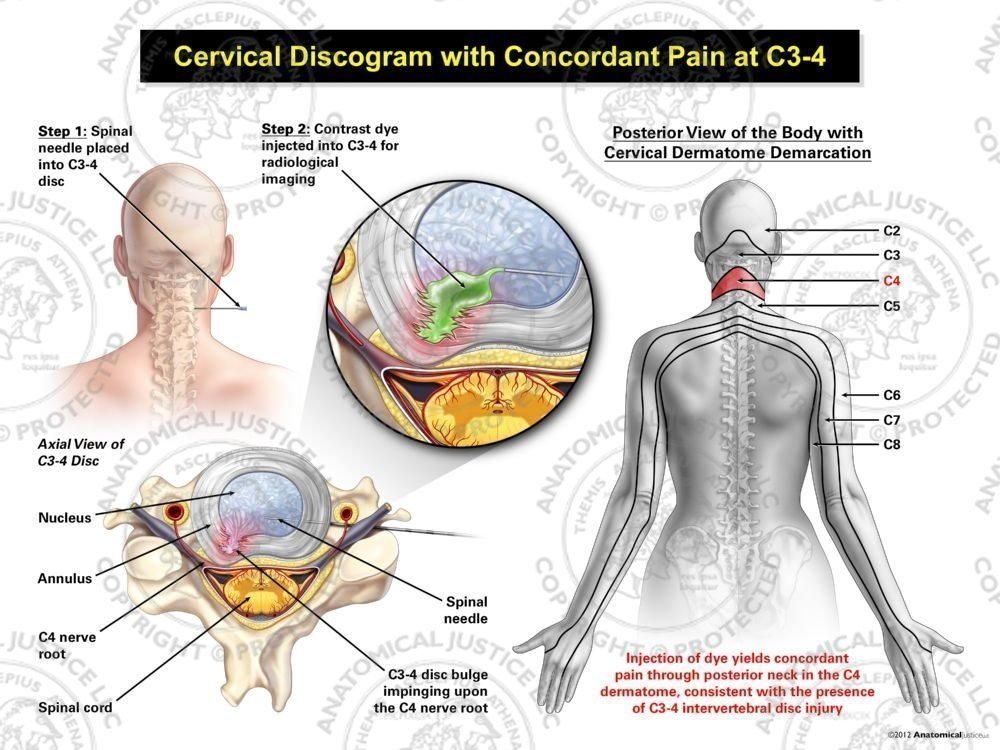 Female Right Cervical Discogram with Concordant Pain at C3-4