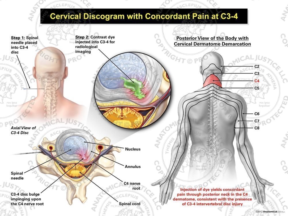Male Left Cervical Discogram with Concordant Pain at C3-4