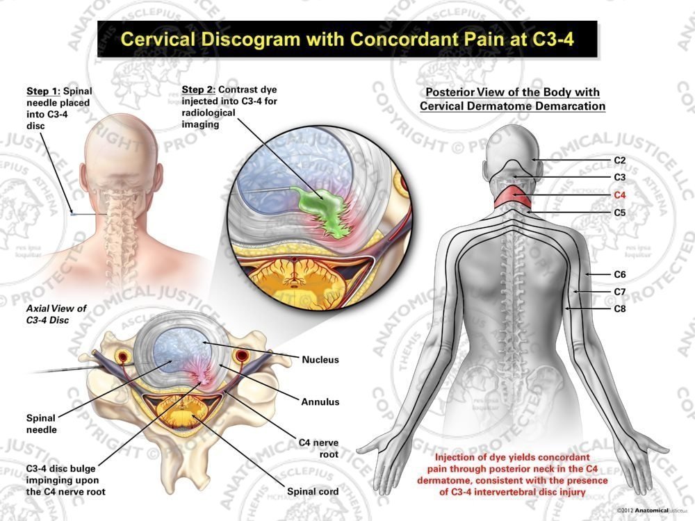 Female Left Cervical Discogram with Concordant Pain at C3-4
