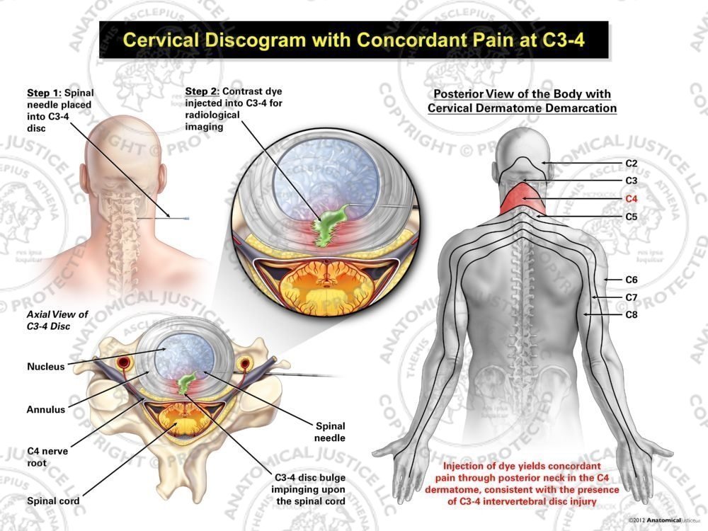 Male Central Cervical Discogram with Concordant Pain at C3-4