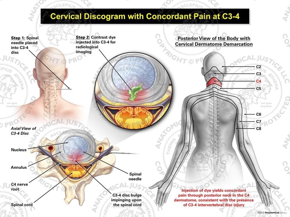 Female Central Cervical Discogram with Concordant Pain at C3-4