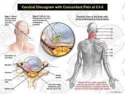 Male Right Cervical Discogram with Concordant Pain at C3-5