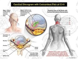 Female Right Cervical Discogram with Concordant Pain at C3-5