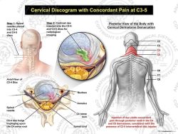 Male Left Cervical Discogram with Concordant Pain at C3-5