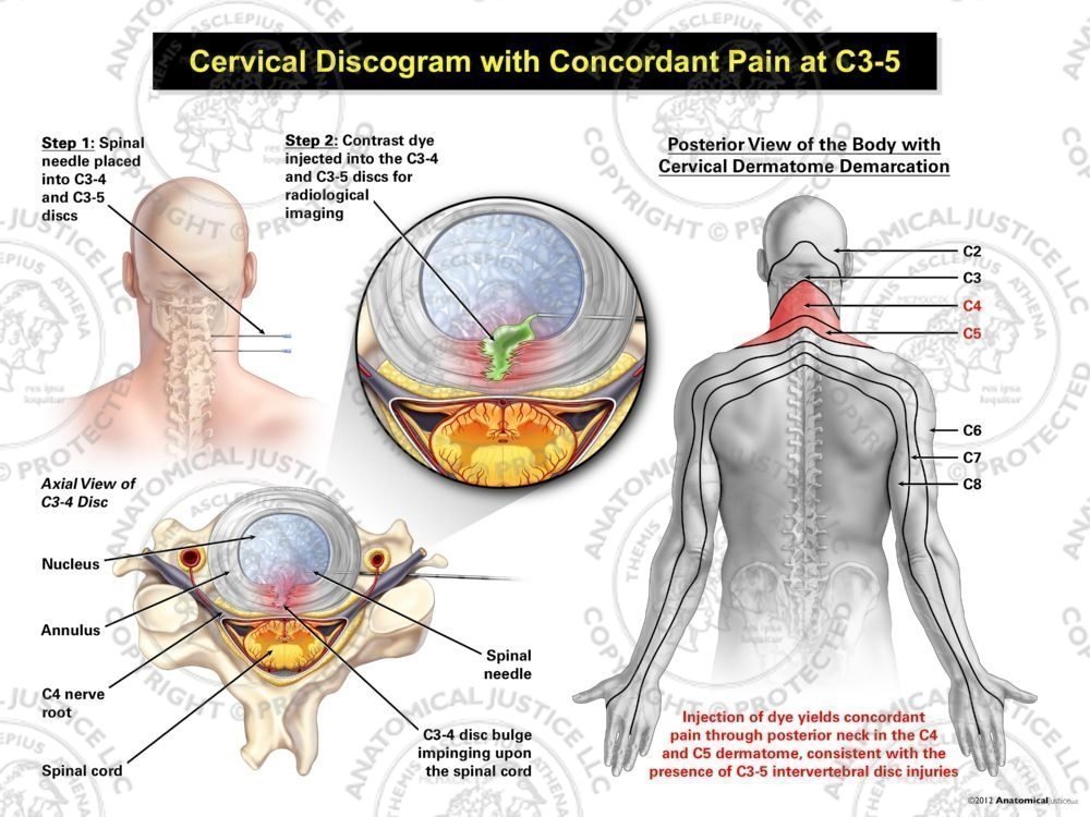 Male Central Cervical Discogram with Concordant Pain at C3-5