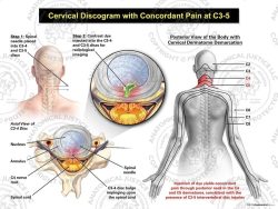 Female Central Cervical Discogram with Concordant Pain at C3-5