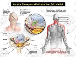 Male Right Cervical Discogram with Concordant Pain at C3-6