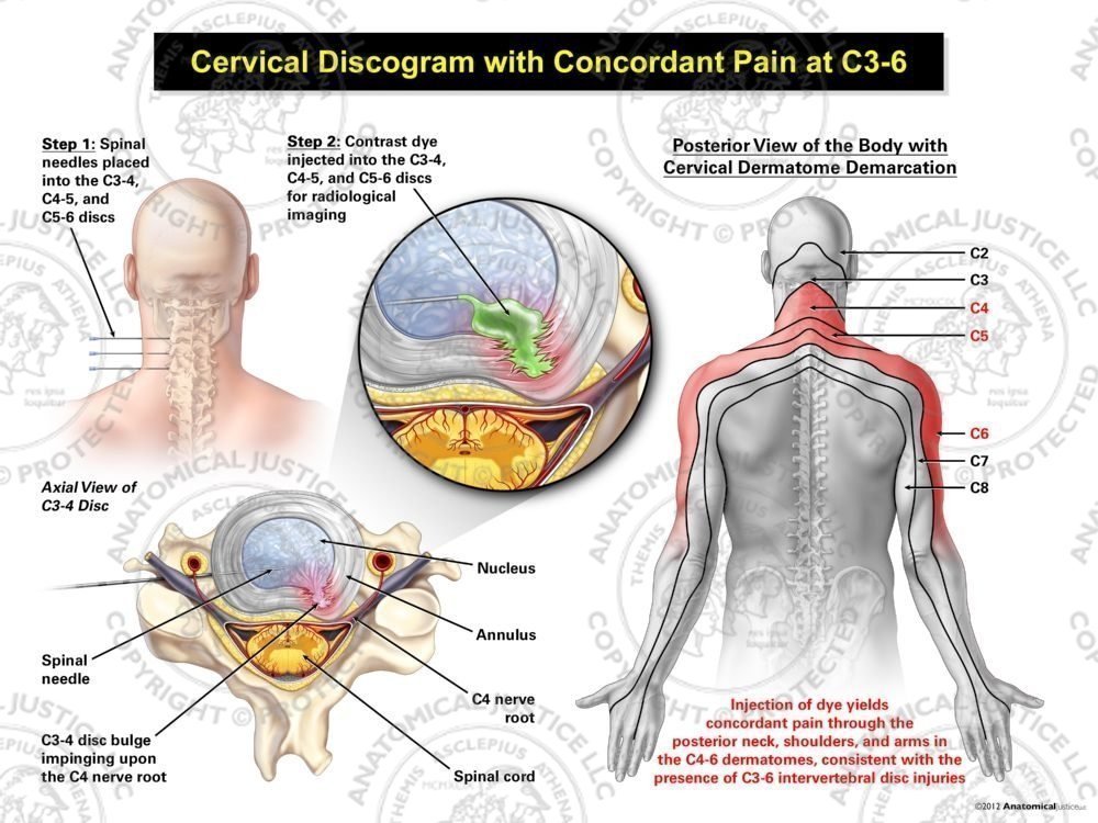 Male Left Cervical Discogram with Concordant Pain at C3-6