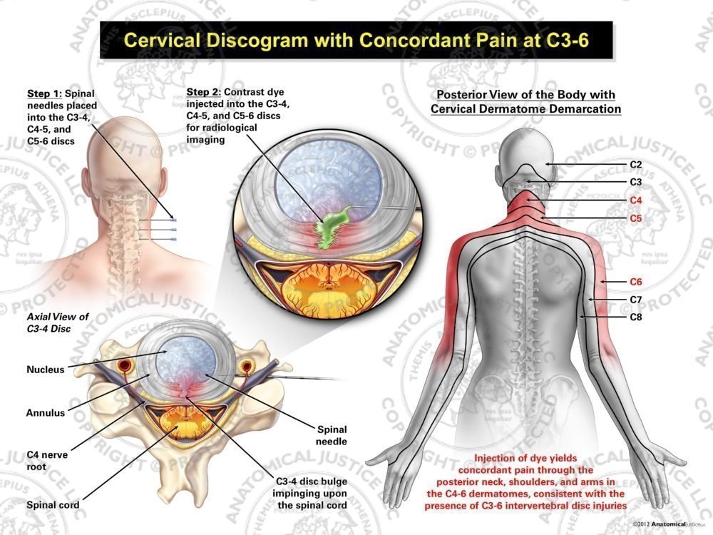 Female Central Cervical Discogram with Concordant Pain at C3-6