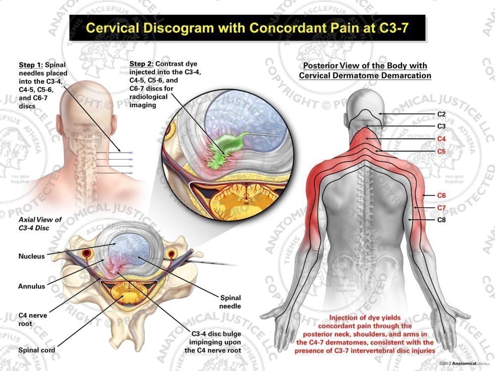 Male Right Cervical Discogram with Concordant Pain at C3-7