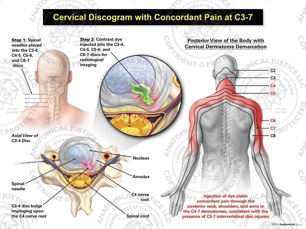 Male Left Cervical Discogram with Concordant Pain at C3-7