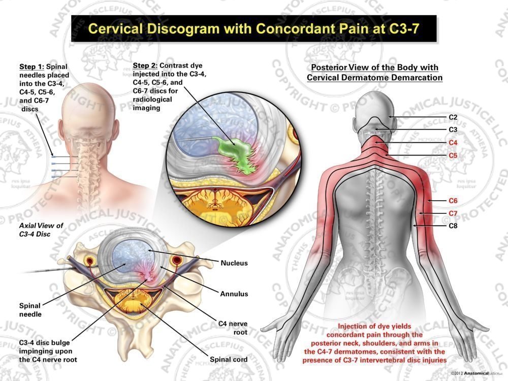 Female Left Cervical Discogram with Concordant Pain at C3-7