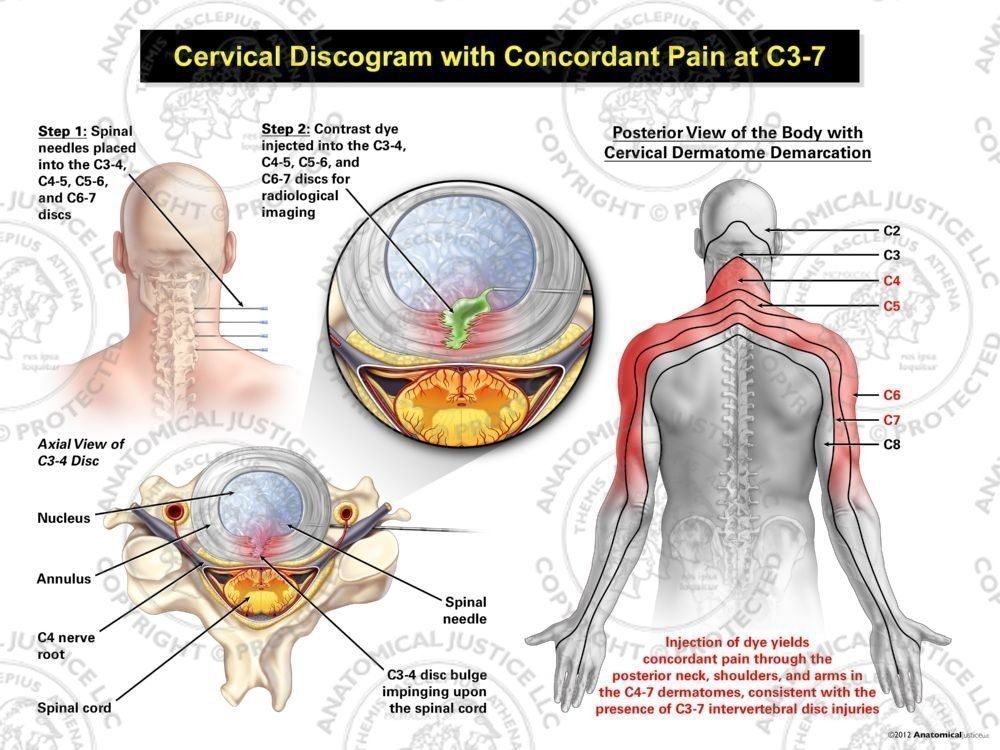 Male Central Cervical Discogram with Concordant Pain at C3-7