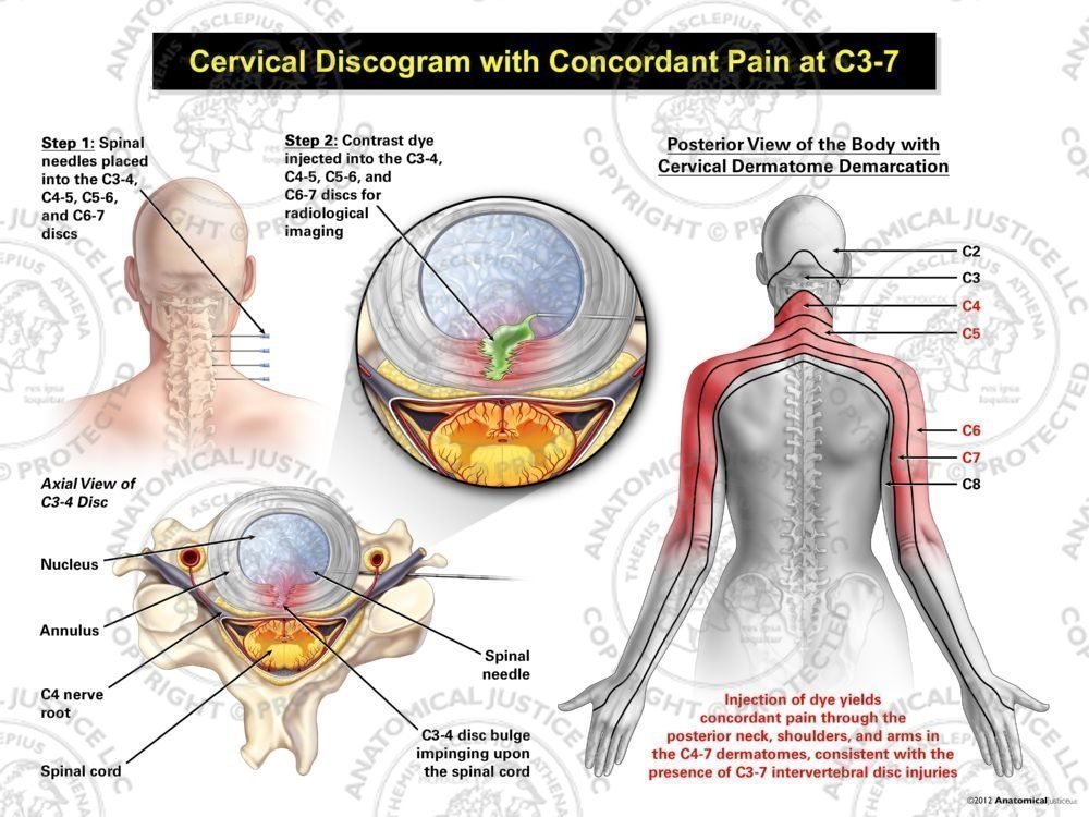 Female Central Cervical Discogram with Concordant Pain at C3-7