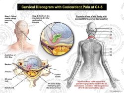 Female Right Cervical Discogram with Concordant Pain at C4-5