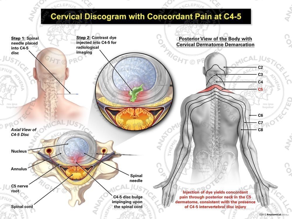 Male Central Cervical Discogram with Concordant Pain at C4-5