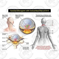 Female Central Cervical Discogram with Concordant Pain at C4-5