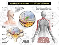 Female Right Cervical Discogram with Concordant Pain at C4-6