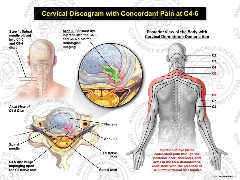 Male Left Cervical Discogram with Concordant Pain at C4-6