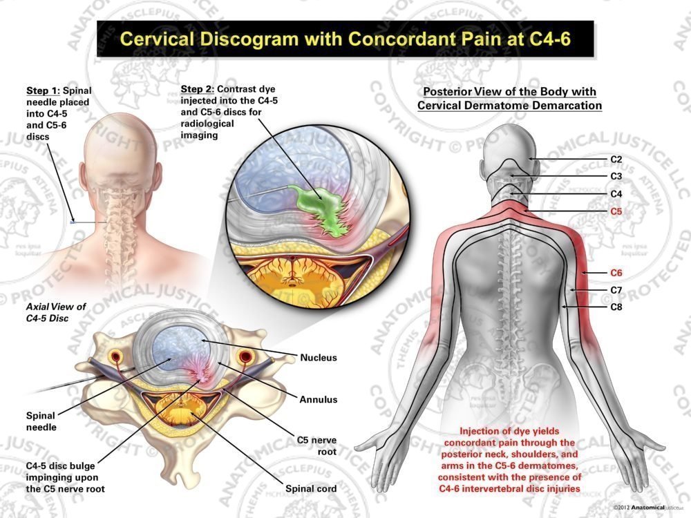 Female Left Cervical Discogram with Concordant Pain at C4-6