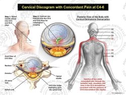 Female Central Cervical Discogram with Concordant Pain at C4-6
