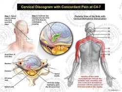 Male Right Cervical Discogram with Concordant Pain at C4-7