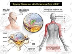 Female Right Cervical Discogram with Concordant Pain at C4-7