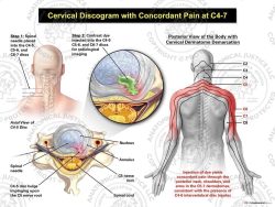 Male Left Cervical Discogram with Concordant Pain at C4-7