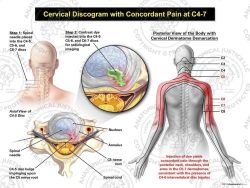 Female Left Cervical Discogram with Concordant Pain at C4-7