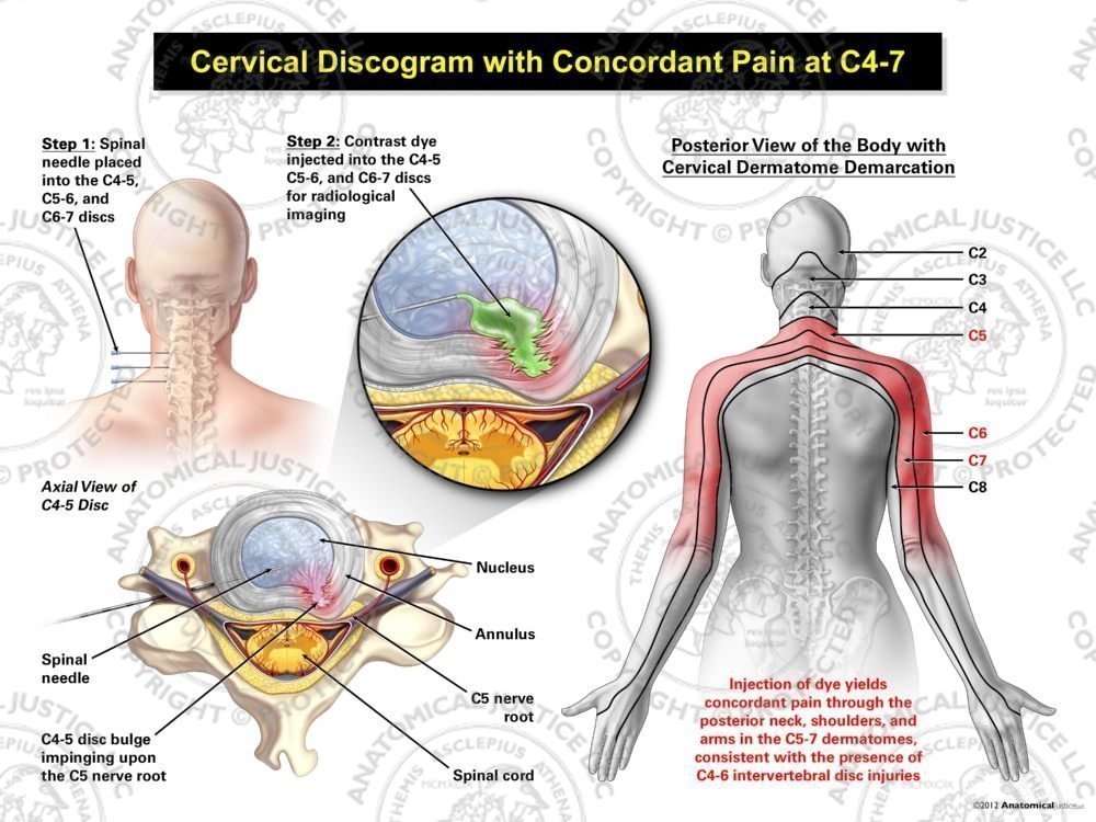 Female Left Cervical Discogram with Concordant Pain at C4-7