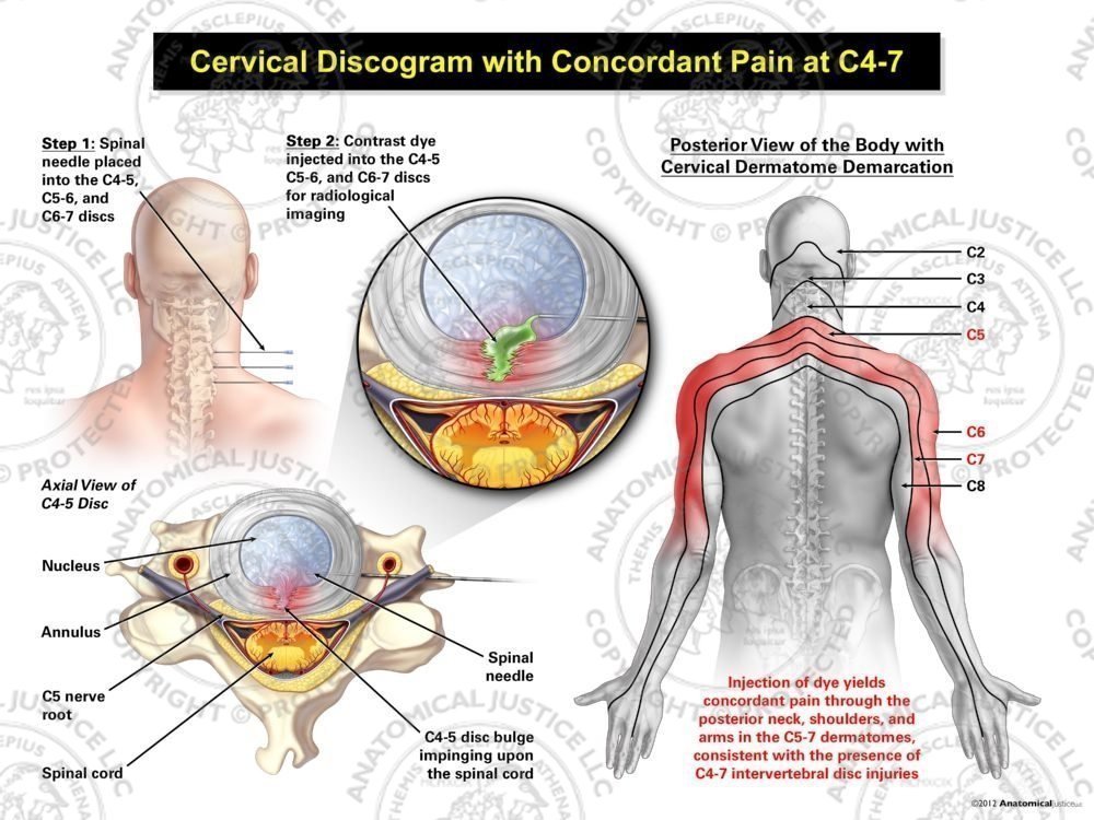 Male Central Cervical Discogram with Concordant Pain at C4-7