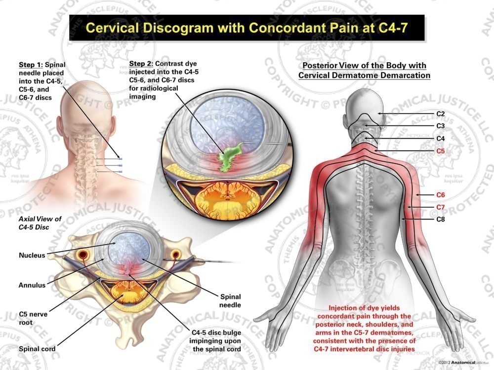 Female Central Cervical Discogram with Concordant Pain at C4-7